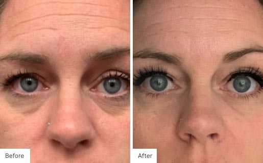 3 - Before and After Real Results photo of a woman's face.